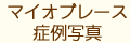 マイオブレース症例